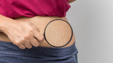 laser stretch mark removal