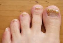 nail fungus